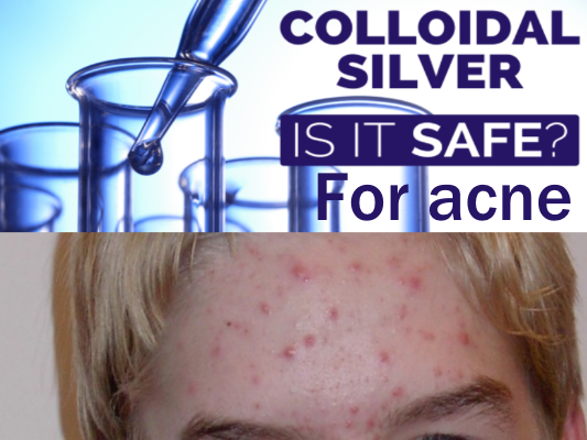 Use Colloidal Silver for Acne and Rosacea